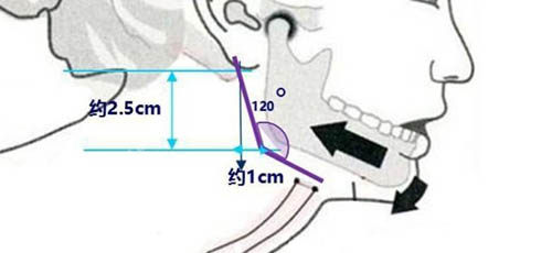 下颌角手术角度设计图