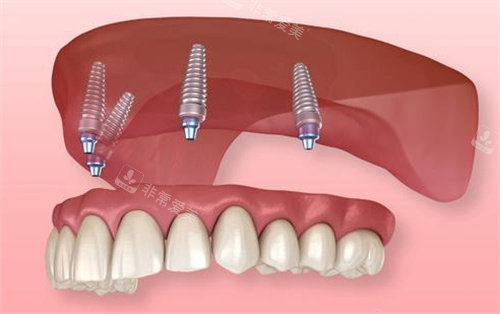 半固定种植牙动画图