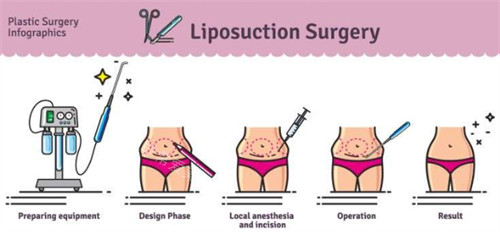 吸脂手术过程图解
