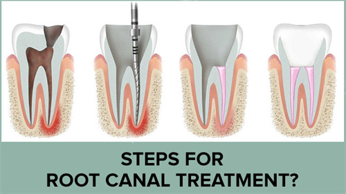 牙齿根管治疗过程