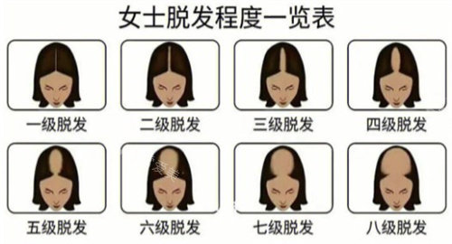 女生发缝正常标准图：一指宽算脱发！女生发缝宽怎么改善
