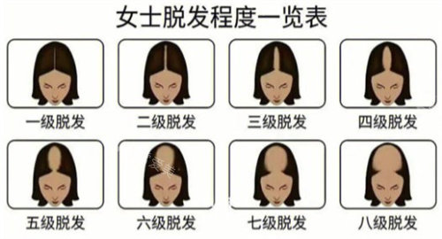 脫發(fā)等級(jí) 脫發(fā)等級(jí)
