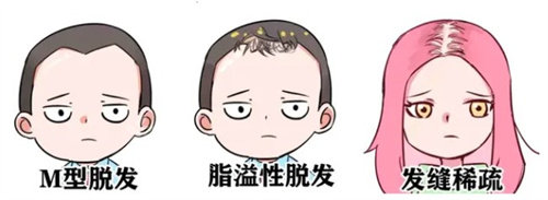 脫發(fā)種類(lèi) 脫發(fā)種類(lèi)