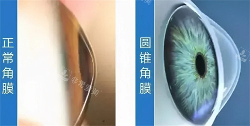 正常角膜和圆锥角膜