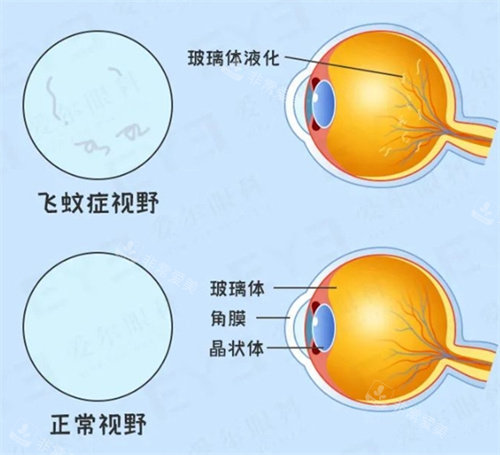 飞蚊症示意图