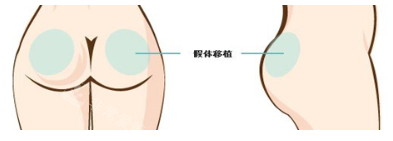 丰臀示意图