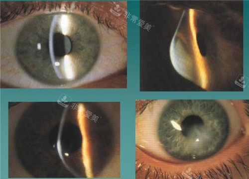 圆锥角膜视力表现照片