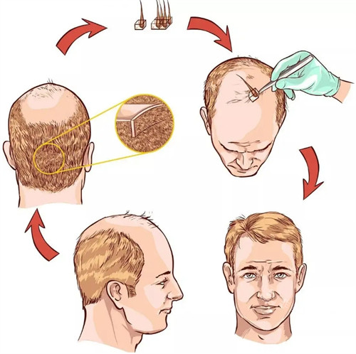 毛发种植手术过程图