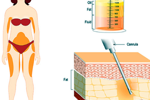 多維吸脂手術(shù)過程圖解