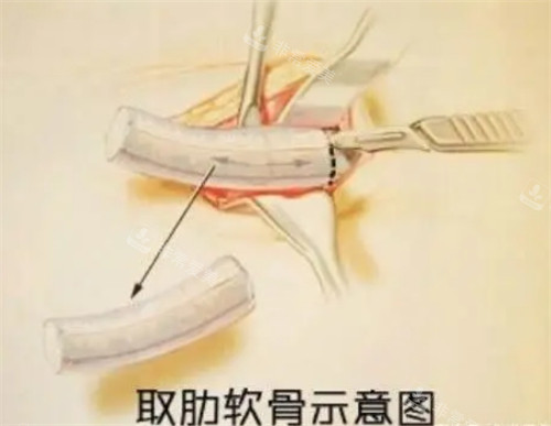 自體肋軟骨隆鼻取骨過程圖解