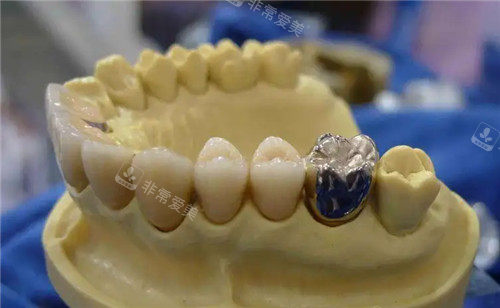 牙冠修复图