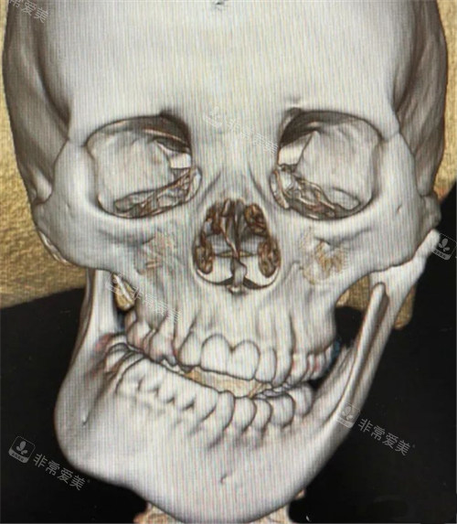 偏颌CT图片