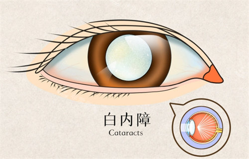 白内障动画图