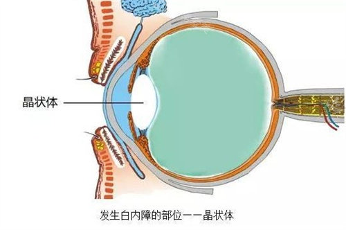白内障晶状体动画图
