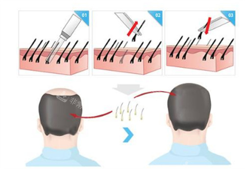微针植发过程图解