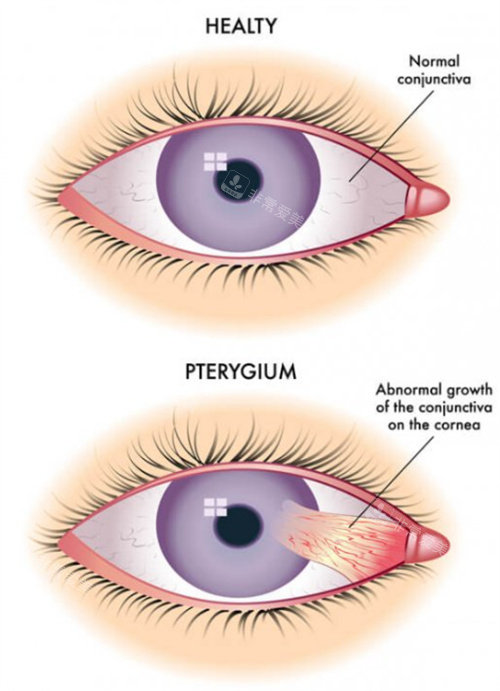 正常眼睛和翼状胬肉