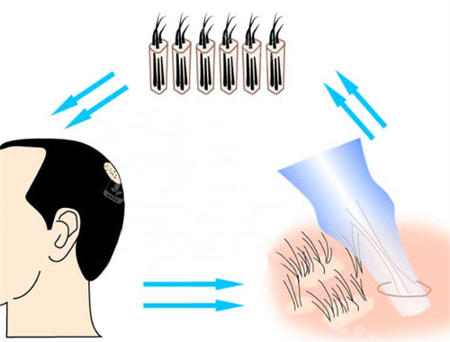 微针吸取毛囊过程图解