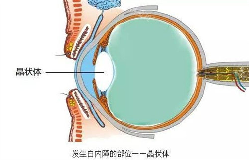 白内障晶状体动画图