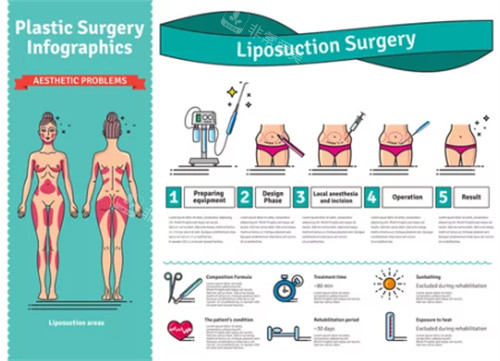 吸脂塑形手术过程