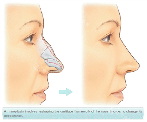 假体隆鼻手术前后对比