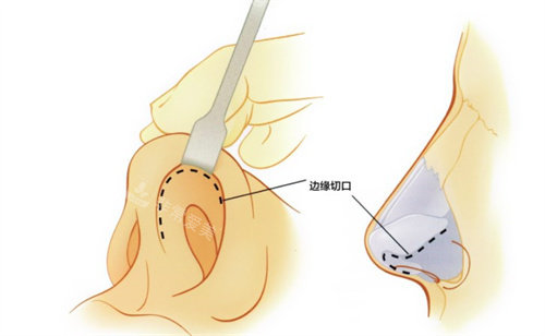 隆鼻手术的切口