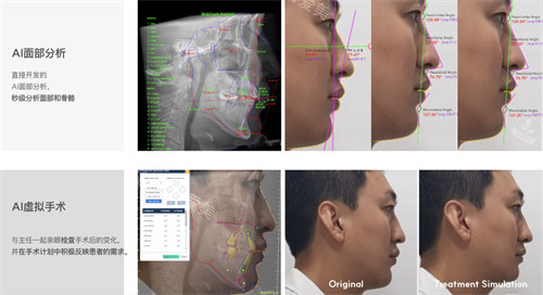 韓國macs口腔頜面外科的雙鄂ai設計讓手術方案精細到0.1毫米!