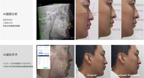 韓國macs口腔頜面外科ai設(shè)計讓手術(shù)方案圖解