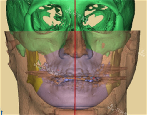 韩国macs口腔颌面外科3D分析技术图解