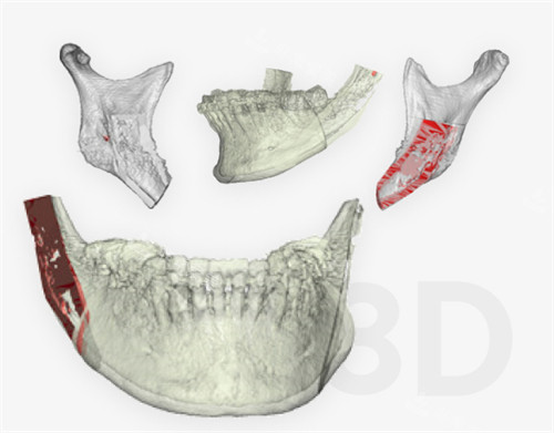 韩国macs口腔颌面外科下颌角3D打印技术图解