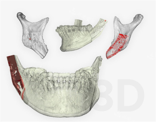 韓國macs口腔頜面外科下頜角3D打印技術(shù)圖解