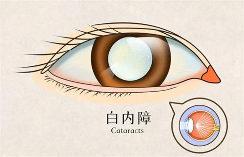 白内障动画图