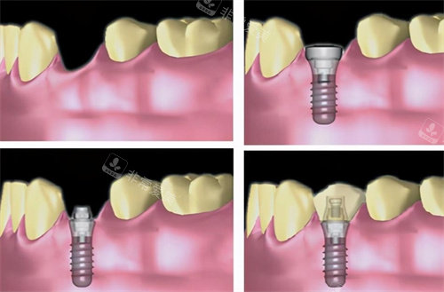 种植牙动画图