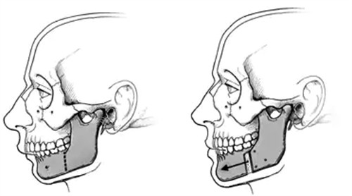 下巴截骨手术前后对比