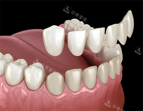 牙齿贴面改善牙齿颜色和牙齿缺损