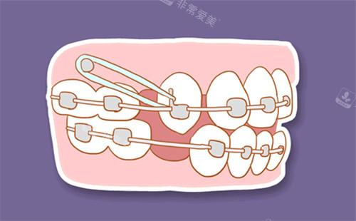 矫正不整齐的牙齿