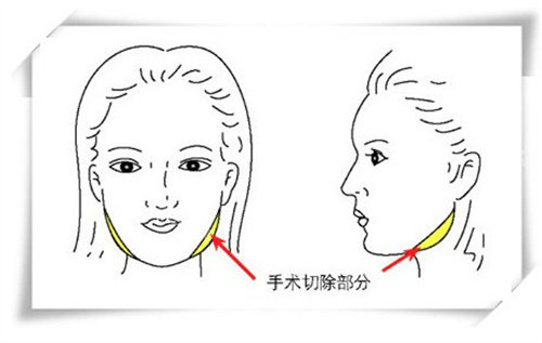 下颌角截骨手术