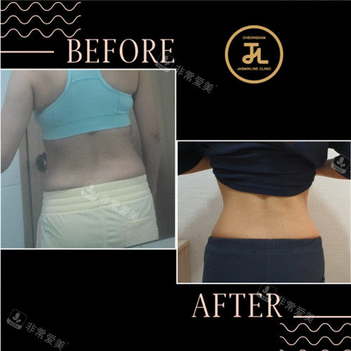 國清潭jasmine line clinic瘦腰前后照片 國清潭jasmine line clinic瘦腰前后照片