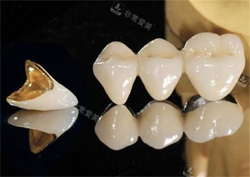 烤瓷牙材料和外观