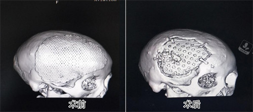 peek材料修复颅骨前后对比