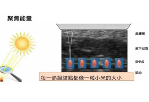 尖峰之星超声王的功能图解