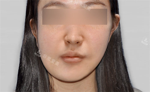 韩国macs口腔颌面外科双鄂手术前