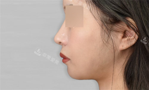 韩国macs口腔颌面外科术后照