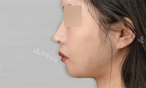 韓國macs口腔頜面外科術(shù)后照 韓國macs口腔頜面外科術(shù)后照