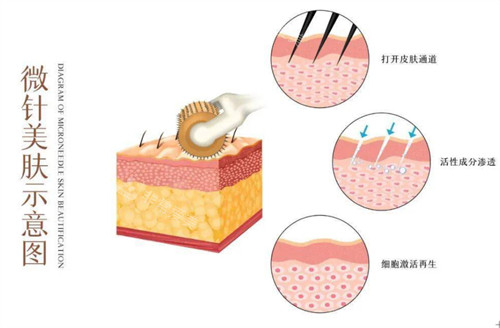 微针美肤操作流程图解