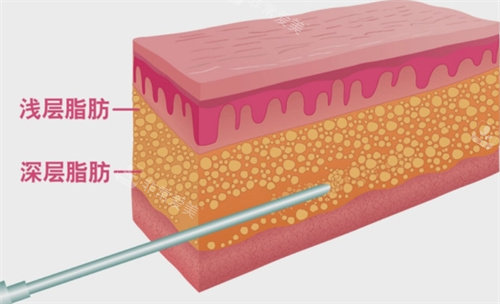 浅层吸脂与深层吸脂动画图