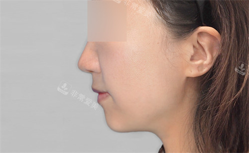 韩国macs口腔颌面外科正颌手术后图片