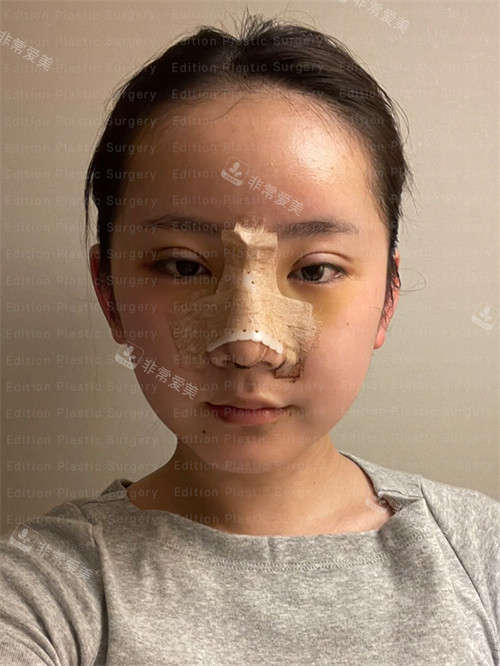 刚刚在韩国艾迪生整形做完眼鼻综合手术的样子