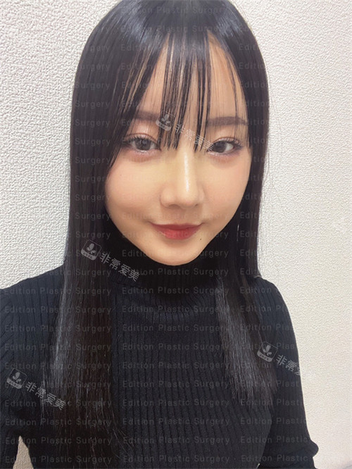 在韓國(guó)艾迪生整形進(jìn)行眼鼻綜合恢復(fù)后的樣子