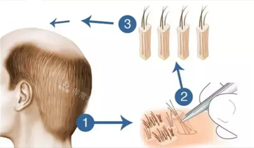 植发手术过程图