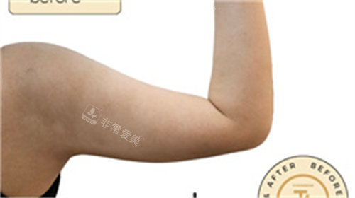 韩国清潭jasmine line clinic手臂塑型前